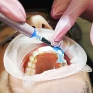 Composite bonding procedure on chipped tooth