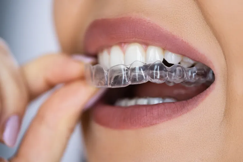 Clear aligners Invisalign orthodontic treatment