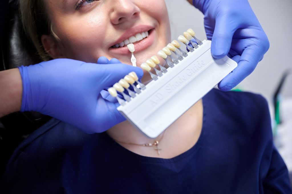 le dentiste utilise le nuancier pour choisir la teinte des facettes
