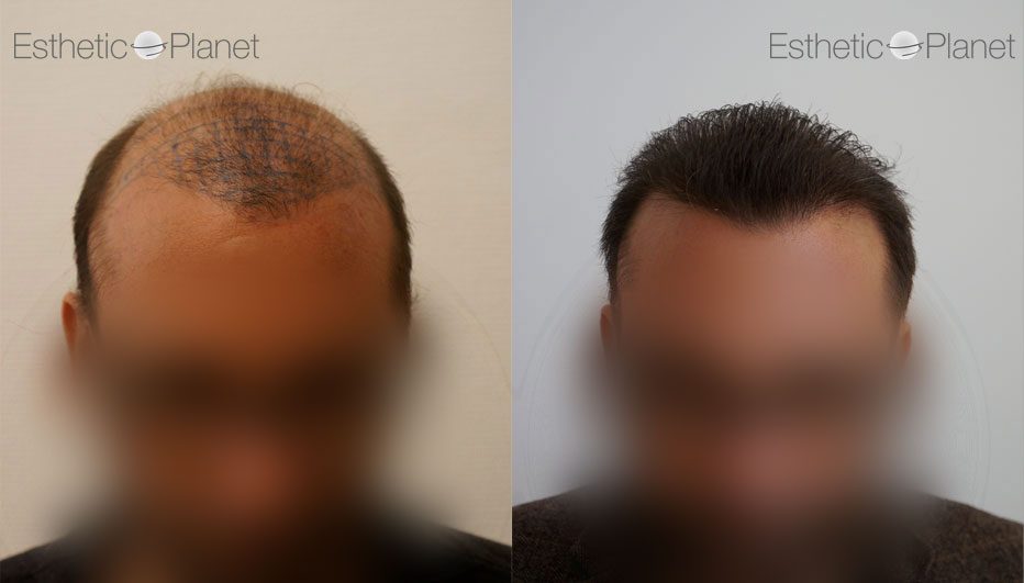 First intervention of 4000 Grafts on significant baldness in FUE in ISTANBUL