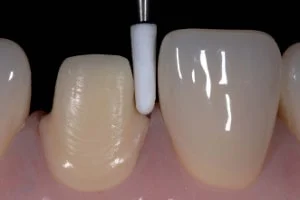 tooth preparation for crowns