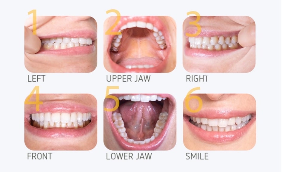 Example of front-facing smile photo for dental quote
