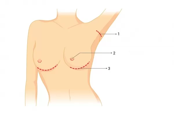 voies d'insertion implants mammaires