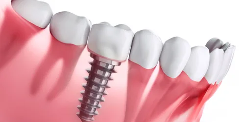 Implants Dentaires
